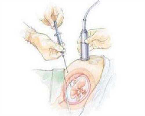 为什么会形成子宫畸形？